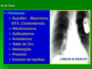 Rx de Tórax
LINEAS B KERLEY
 Fármacos:
 Busulfan, Bleomicina,
MTX, Ciclofosfamida.
 Nitrofurantoina.
 Sulfazalacina.
 Amiodarona.
 Sales de Oro.
 Metisergida.
 Practolol.
 Extracto de hipofisis.
 
