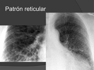 Intersticio pulmonar | PPTX