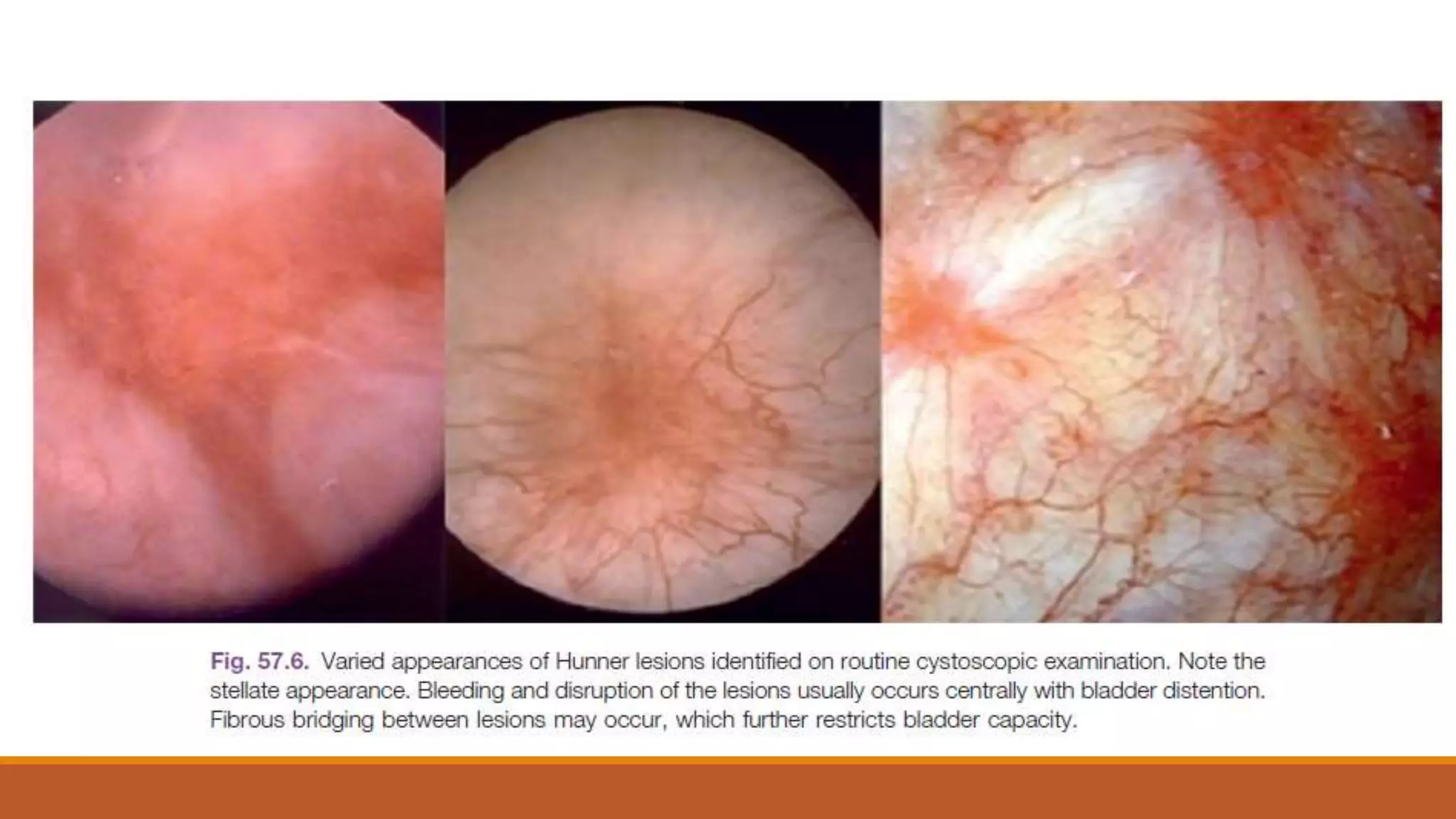 Inter Cystitis interstital cystitis bladder pain syndrome etiology and diagnosis.pptx ...