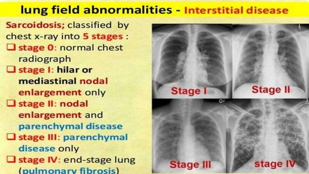 Interstitial lung disease (ILD) ppt slideshare | PPTX | Lung and ...