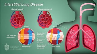 Interstitial lung disease (ILD) ppt slideshare | PPTX