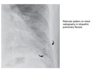 Picture Frame Pattern Radiography Comprehensive Medical Overview of Interstitial Lung Disease ...