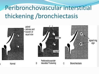 Un Interstice Interstitial lung-diseases | PPTX