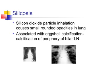 Silicosis
 Silicon dioxide particle inhalation
couses small rounded opacities in lung
 Associated with eggshell calcification-
calcification of periphery of hilar LN
 