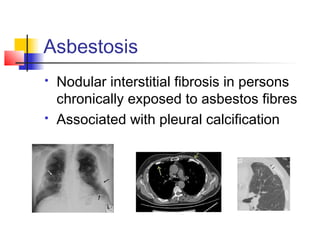 Asbestosis
 Nodular interstitial fibrosis in persons
chronically exposed to asbestos fibres
 Associated with pleural calcification
 