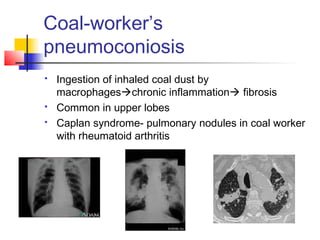 Coal-worker’s
pneumoconiosis
 Ingestion of inhaled coal dust by
macrophageschronic inflammation fibrosis
 Common in upper lobes
 Caplan syndrome- pulmonary nodules in coal worker
with rheumatoid arthritis
 