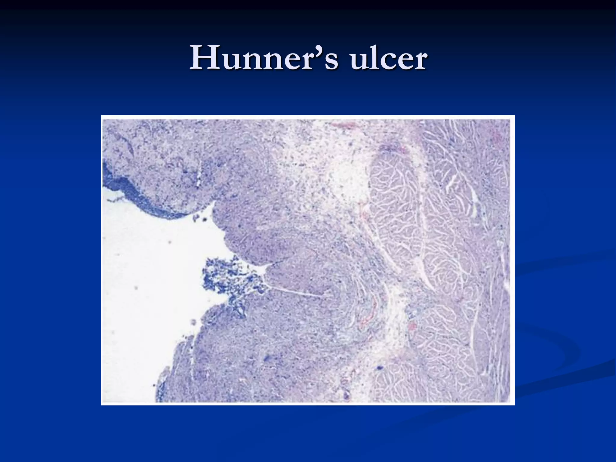 Hunner’s ulcer
 