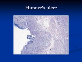 Hunner’s ulcer
 