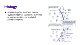 Etiology
● Urothelial dysfunction (GAG): Normal
glycosaminoglycan layer (GAG) is affected
by a defect/inhibition of urothelial
proliferation (APF).
 