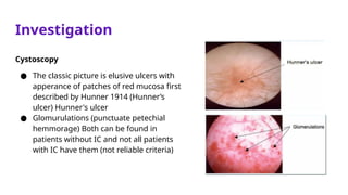 Investigation
Cystoscopy
● The classic picture is elusive ulcers with
apperance of patches of red mucosa first
described by Hunner 1914 (Hunner’s
ulcer) Hunner's ulcer
● Glomurulations (punctuate petechial
hemmorage) Both can be found in
patients without IC and not all patients
with IC have them (not reliable criteria)
 
