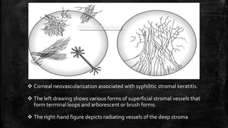  Corneal neovascularization associated with syphilitic stromal keratitis.
 The left drawing shows various forms of superficial stromal vessels that
form terminal loops and arborescent or brush forms.
 The right-hand figure depicts radiating vessels of the deep stroma
 