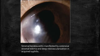 Stromal keratouveitis manifested by extensive
stromal edema and deep neovascularization in
acquired syphilis.
 