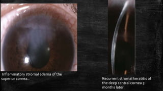 Inflammatory stromal edema of the
superior cornea.. Recurrent stromal keratitis of
the deep central cornea 5
months later
 