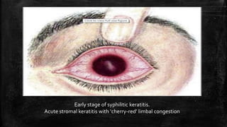 Early stage of syphilitic keratitis.
Acute stromal keratitis with ‘cherry-red’ limbal congestion
 