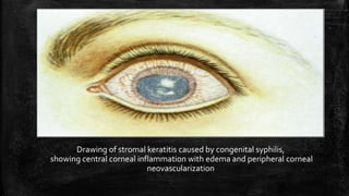 Drawing of stromal keratitis caused by congenital syphilis,
showing central corneal inflammation with edema and peripheral corneal
neovascularization
 