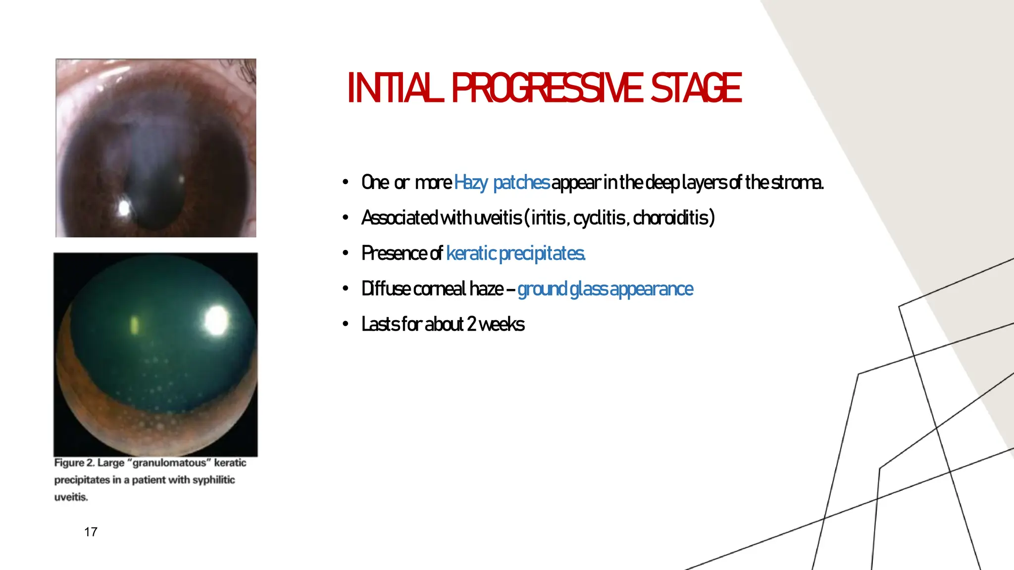 Interstitial keratitis PowerPoint presentation | PPTX