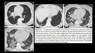 Interstitial Lung Abnormalities in CT.pptx