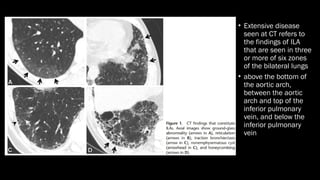 Interstitial Lung Abnormalities in CT.pptx