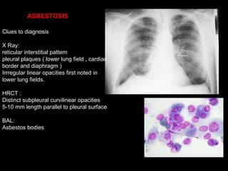 Clues to diagnosis X Ray: reticular interstitial pattern  pleural plaques ( lower lung field , cardiac border and diaphragm ) Irrregular linear opacities first noted in lower lung fields. HRCT : Distinct subpleural curvilinear opacities 5-10 mm length parallel to pleural surface BAL: Asbestos bodies  ASBESTOSIS 