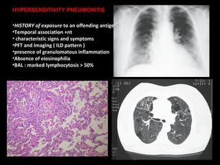 HISTORY of exposure  to an offending antigen Temporal association +nt characteristic signs and symptoms PFT and Imaging ( ILD pattern ) presence of granulomatous inflammation Absence of eiosinophilia BAL : marked lymphocytosis > 50% HYPERSENSITIVITY PNEUMONITIS 