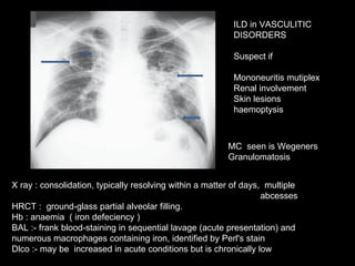 X ray : consolidation, typically resolving within a matter of days,  multiple  abcesses HRCT :  ground-glass partial alveolar filling.  Hb : anaemia  ( iron defeciency ) BAL :-  frank blood-staining in sequential lavage (acute presentation) and numerous macrophages containing iron, identified by Perl's stain Dlco :- may be  increased in acute conditions but is chronically low MC  seen is Wegeners Granulomatosis ILD in VASCULITIC DISORDERS Suspect if  Mononeuritis mutiplex Renal involvement Skin lesions haemoptysis 