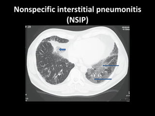 Nonspecific interstitial pneumonitis (NSIP) 