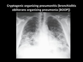 Cryptogenic organizing pneumonitis (bronchiolitis obliterans organizing pneumonia [BOOP])   