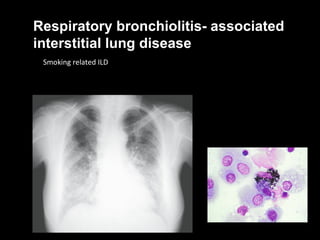 Smoking related ILD Respiratory bronchiolitis- associated interstitial lung disease  