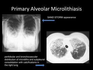 Primary Alveolar Microlithiasis perilobular and bronchovascular distribution of microliths and subpleural consolidation with calcifications in the right lung SAND STORM appearance 
