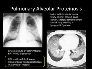 Pulmonary Alveolar Proteinosis diffuse reticulo-alveolar infiltrates  BAT WING distribution BAL :- milky effulent foamy macrophages with lipoproteinous intraalveolar  material thickened interlobular septa “ crazy paving” ground glass fashion, sharply demarked from normal  lung creating a “geographic” pattern. 