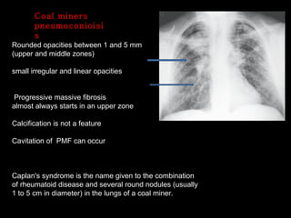 Coal miners pneumoconioisis Rounded opacities between 1 and 5 mm (upper and middle zones) small irregular and linear opacities Progressive massive fibrosis  almost always starts in an upper zone Calcification is not a feature Cavitation of  PMF can occur Caplan's syndrome is the name given to the combination of rheumatoid disease and several round nodules (usually 1 to 5 cm in diameter) in the lungs of a coal miner. 