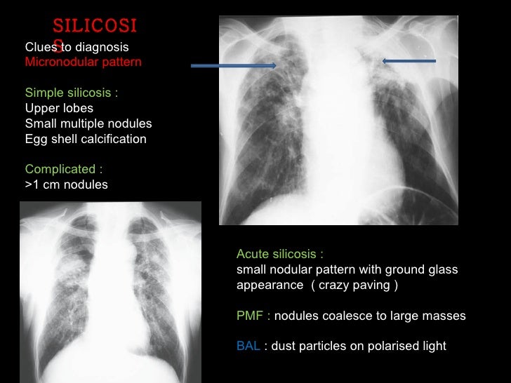 Interstitial Lung Disease