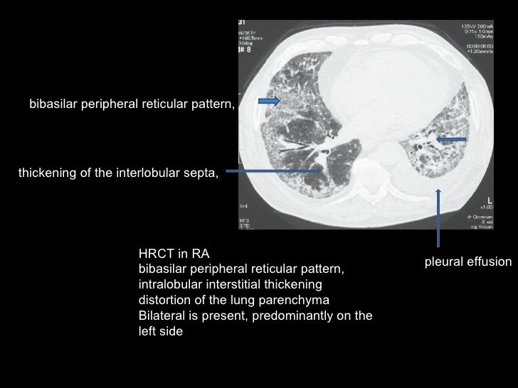 Reticular interstitial pattern