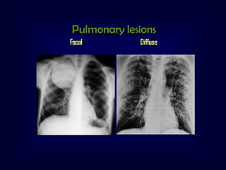 Pulmonary lesions
Focal

Diffuse

 