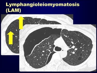 Lymphangioleiomyomatosis
(LAM)

 