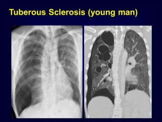 Tuberous Sclerosis (young man)

 