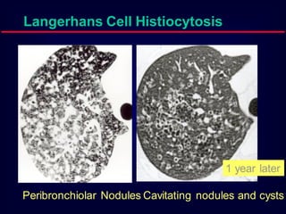 Langerhans Cell Histiocytosis

1 year later
Peribronchiolar Nodules Cavitating nodules and cysts

 