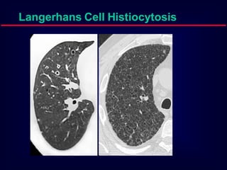 Langerhans Cell Histiocytosis

 