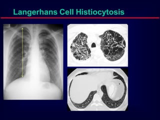 Langerhans Cell Histiocytosis

 