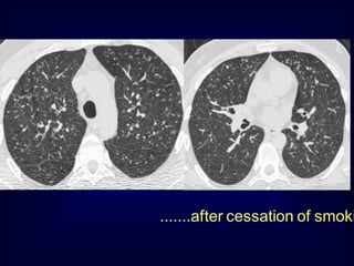 .......after cessation of smoki

 