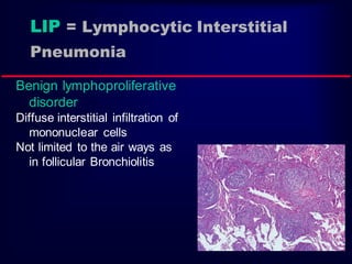LIP = Lymphocytic Interstitial
Pneumonia
Benign lymphoproliferative
disorder
Diffuse interstitial infiltration of
mononuclear cells
Not limited to the air ways as
in follicular Bronchiolitis

 