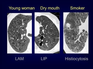 Young woman

LAM

Dry mouth

LIP

Smoker

Histiocytosis

 