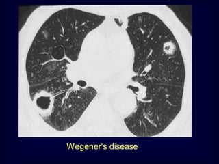 Wegener‘s disease

 