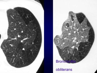 Bronchiolitis

obliterans

 