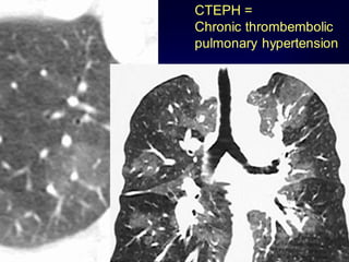 CTEPH =
Chronic thrombembolic
pulmonary hypertension

 