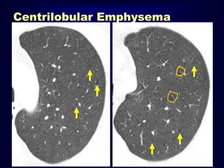 Centrilobular Emphysema

 