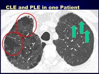 CLE and PLE in one Patient

 