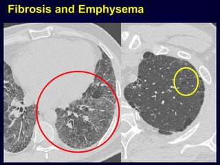 Fibrosis and Emphysema

 