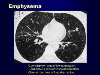 Emphysema

•Curved arrow: area of low attenuation.
•Solid arrow: zones of vascular disruption.
•Open arrow: area of lung destruction.

 