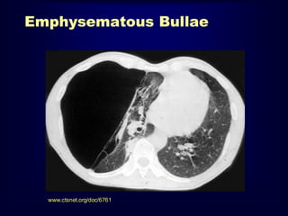 Emphysematous Bullae

www.ctsnet.org/doc/6761

 